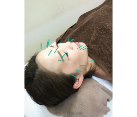 カッピングと美容鍼灸を体験しました 中央区KN様